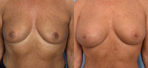 Breast Augmentation with Fat Before & After Patient Miniature Set