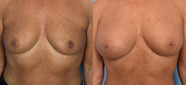 Photo of the patient’s body before & after the Breast Augmentation with Fat surgery. Set 1: Patient 3