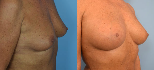 Photo of the patient’s body before & after the Breast Augmentation with Fat surgery. Set 2: Patient 3