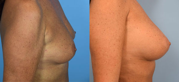 Photo of the patient’s body before & after the Breast Augmentation with Fat surgery. Set 3: Patient 3