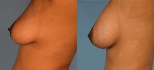 Breast Augmentation with Fat Before & After Patient4