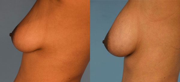 Photo of the patient’s body before & after the Breast Augmentation with Fat surgery. Set 1: Patient 4