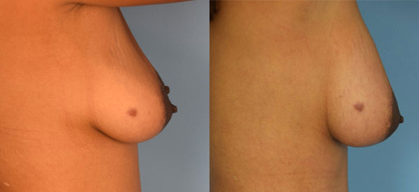 Photo of the patient’s body before & after the Breast Augmentation with Fat surgery. Set 2: Patient 4