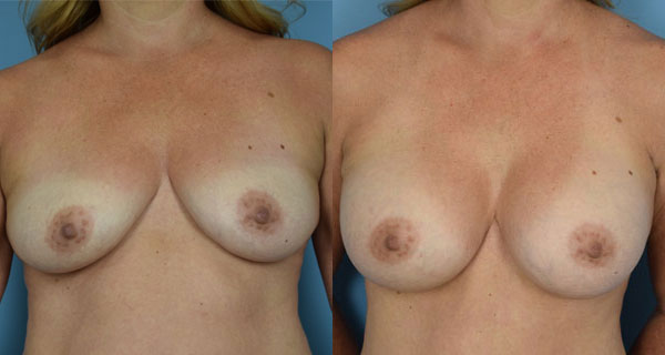 Photo of the patient’s body before & after the Breast Augmentation with Implantst surgery. Set 1: Patient 1
