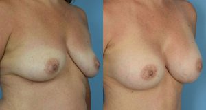 Breast Augmentation with Implants Before & After Patient Miniature Set