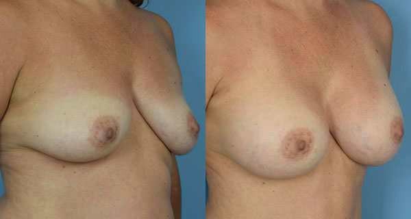 Photo of the patient’s body before & after the Breast Augmentation with Implantst surgery. Set 2: Patient 1