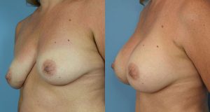 Breast Augmentation with Implants Before & After Patient Miniature Set