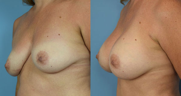 Photo of the patient’s body before & after the Breast Augmentation with Implantst surgery. Set 3: Patient 1