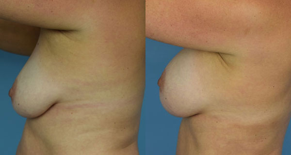 Photo of the patient’s body before & after the Breast Augmentation with Implantst surgery. Set 4: Patient 1