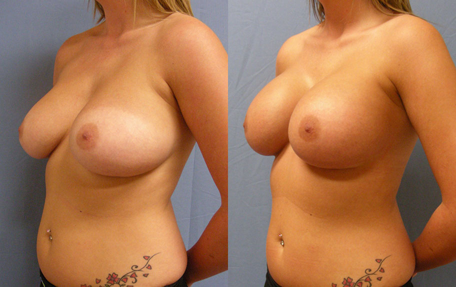 Photo of the patient’s body before & after the Breast Augmentation with Implantst surgery. Set 2: Patient 11