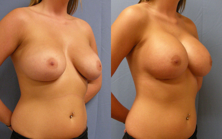 Photo of the patient’s body before & after the Breast Augmentation with Implantst surgery. Set 4: Patient 11