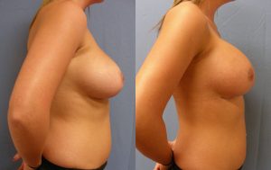 Breast Augmentation with Implants Before & After Patient Miniature Set