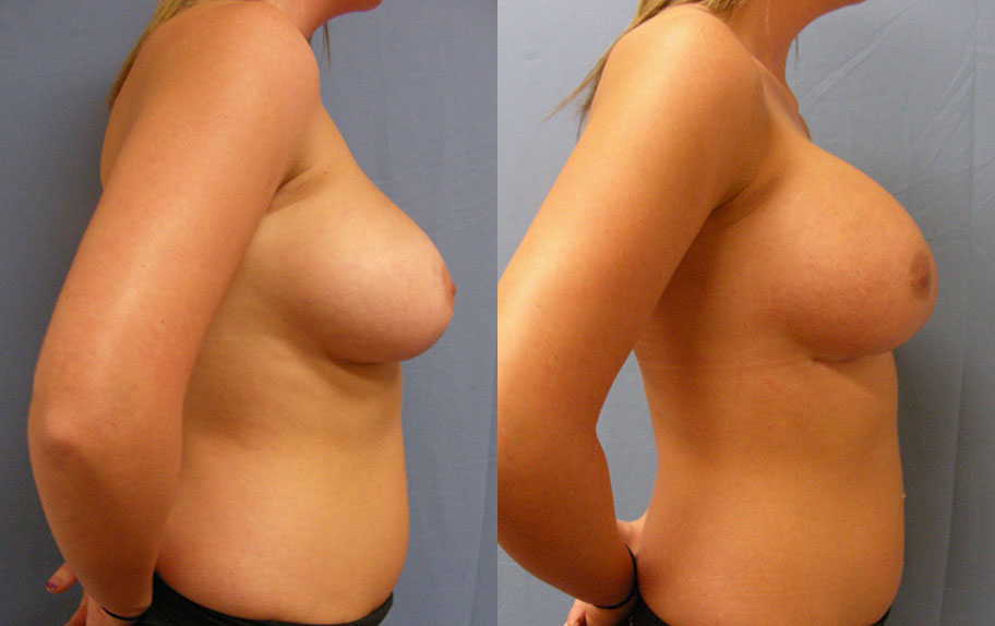 Photo of the patient’s body before & after the Breast Augmentation with Implantst surgery. Set 3: Patient 11