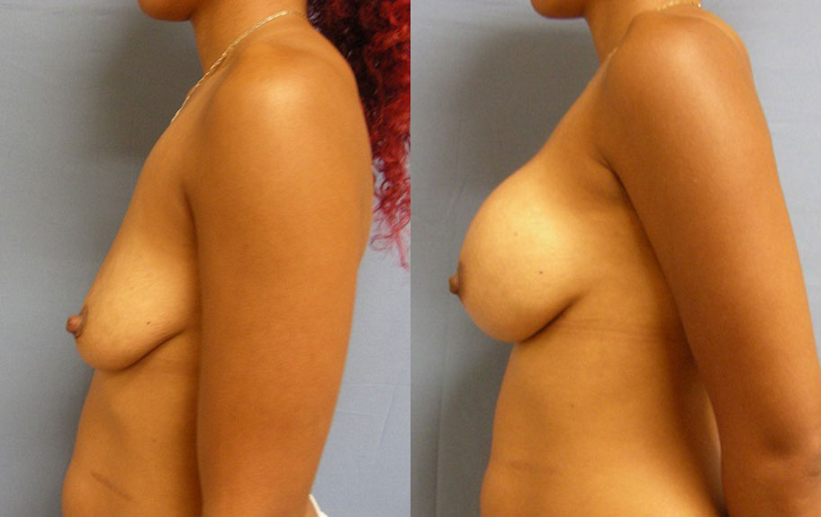 Photo of the patient’s body before & after the Breast Augmentation with Implantst surgery. Set 2: Patient 12
