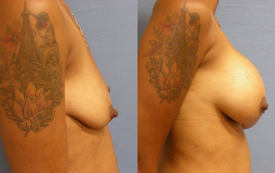 Photo of the patient’s body before & after the Breast Augmentation with Implantst surgery. Set 4: Patient 12
