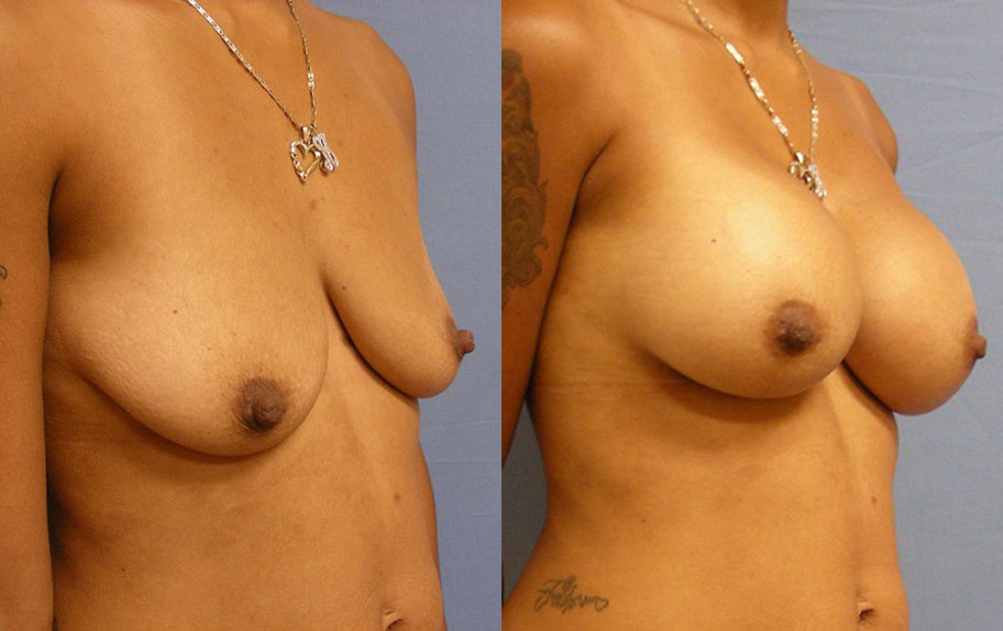 Photo of the patient’s body before & after the Breast Augmentation with Implantst surgery. Set 3: Patient 12