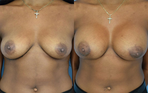Photo of the patient’s body before & after the Breast Augmentation with Implantst surgery. Set 1: Patient 13