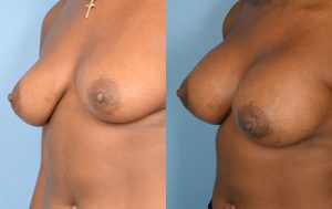 Breast Augmentation with Implants Before & After Patient Miniature Set