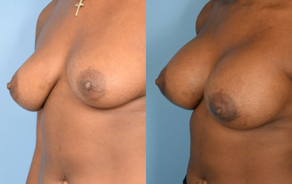 Photo of the patient’s body before & after the Breast Augmentation with Implantst surgery. Set 2: Patient 13