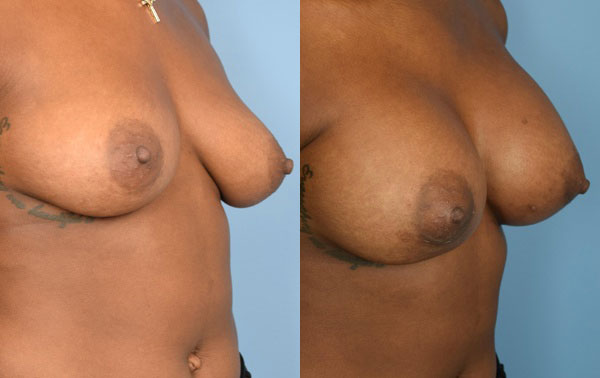 Photo of the patient’s body before & after the Breast Augmentation with Implantst surgery. Set 3: Patient 13