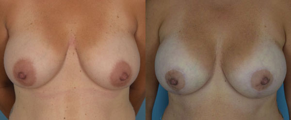 Photo of the patient’s body before & after the Breast Augmentation with Implantst surgery. Set 1: Patient 14