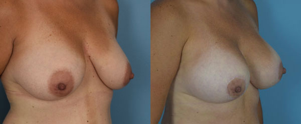 Photo of the patient’s body before & after the Breast Augmentation with Implantst surgery. Set 2: Patient 14