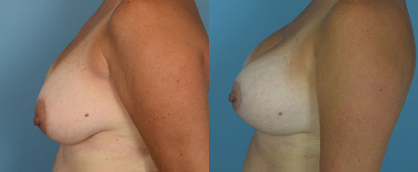 Photo of the patient’s body before & after the Breast Augmentation with Implantst surgery. Set 2: Patient 14