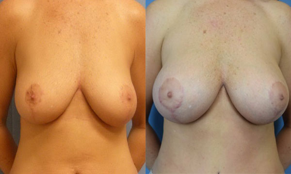 Photo of the patient’s body before & after the Breast Augmentation with Implantst surgery. Set 1: Patient 15