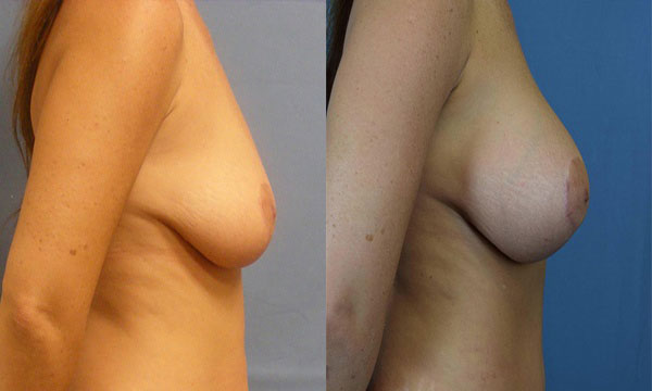 Photo of the patient’s body before & after the Breast Augmentation with Implantst surgery. Set 2: Patient 15