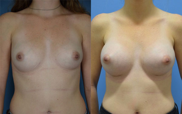 Photo of the patient’s body before & after the Breast Augmentation with Implantst surgery. Set 1: Patient 16