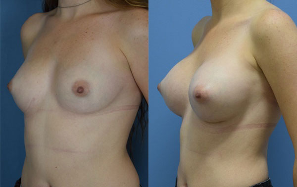 Photo of the patient’s body before & after the Breast Augmentation with Implantst surgery. Set 2: Patient 16