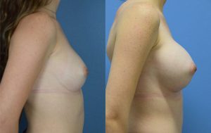 Breast Augmentation with Implants Before & After Patient Miniature Set