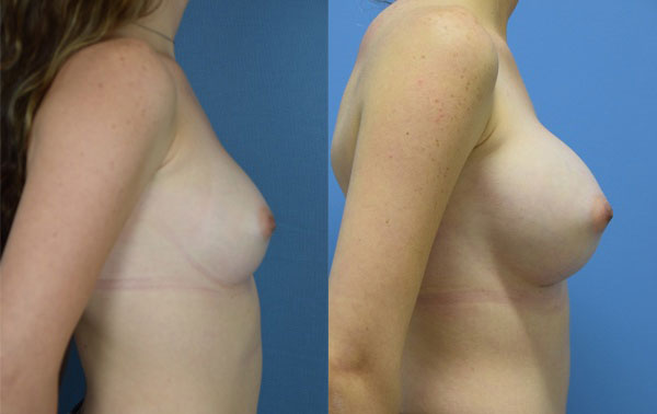 Photo of the patient’s body before & after the Breast Augmentation with Implantst surgery. Set 3: Patient 16