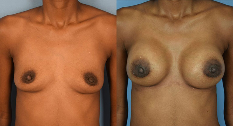 Photo of the patient’s body before & after the Breast Augmentation with Implantst surgery. Set 1: Patient 17