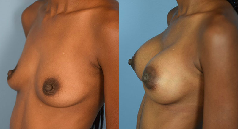Photo of the patient’s body before & after the Breast Augmentation with Implantst surgery. Set 2: Patient 17