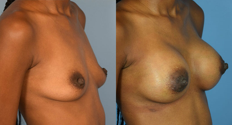 Photo of the patient’s body before & after the Breast Augmentation with Implantst surgery. Set 3: Patient 17