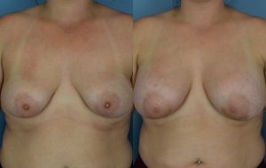 Breast Augmentation with Implants Before & After Patient Miniature Set