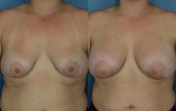 Photo of the patient’s body before & after the Breast Augmentation with Implantst surgery. Set 1: Patient 18