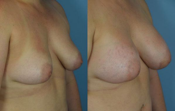 Photo of the patient’s body before & after the Breast Augmentation with Implantst surgery. Set 2: Patient 18