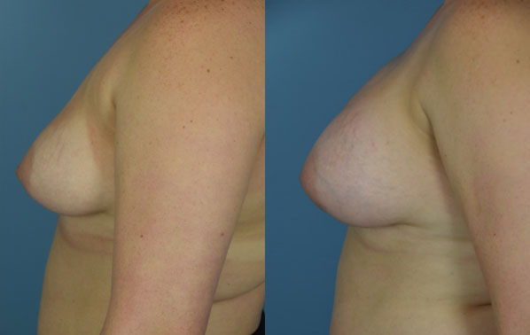 Photo of the patient’s body before & after the Breast Augmentation with Implantst surgery. Set 3: Patient 18
