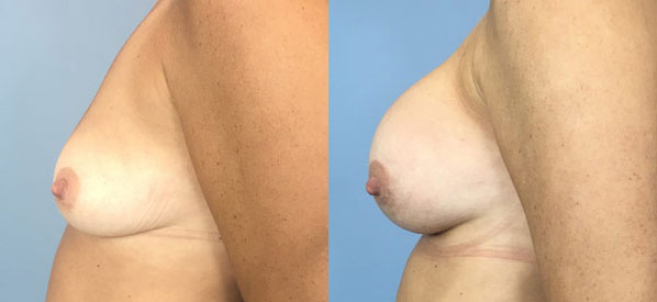 Photo of the patient’s body before & after the Breast Augmentation with Implantst surgery. Set 2: Patient 19