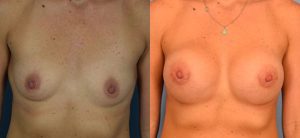 Breast Augmentation with Implants Before & After Patient Miniature Set