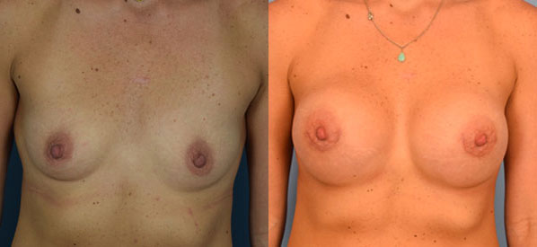 Photo of the patient’s body before & after the Breast Augmentation with Implantst surgery. Set 1: Patient 20