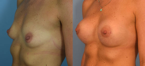 Photo of the patient’s body before & after the Breast Augmentation with Implantst surgery. Set 2: Patient 20