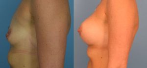 Breast Augmentation with Implants Before & After Patient Miniature Set