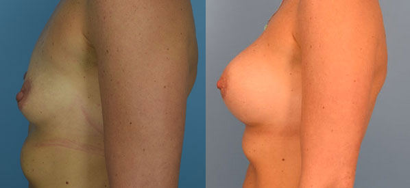 Photo of the patient’s body before & after the Breast Augmentation with Implantst surgery. Set 3: Patient 20