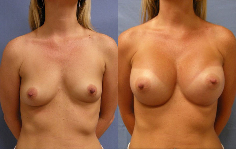 Photo of the patient’s body before & after the Breast Augmentation with Implantst surgery. Set 1: Patient 2