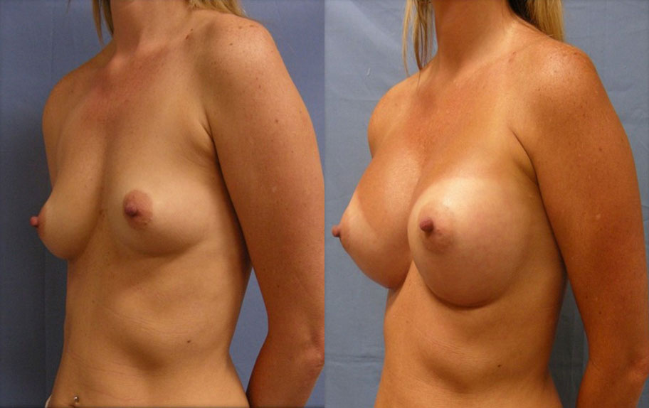 Photo of the patient’s body before & after the Breast Augmentation with Implantst surgery. Set 2: Patient 2
