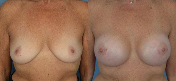 Photo of the patient’s body before & after the Breast Augmentation with Implantst surgery. Set 1: Patient 21