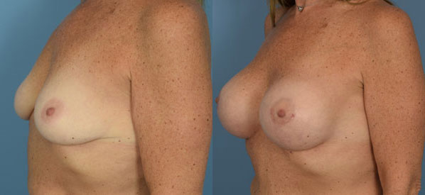 Breast Augmentation with Implants Before & After Patient Set